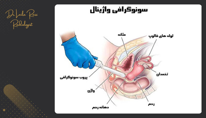 سونوگرافی واژینال 