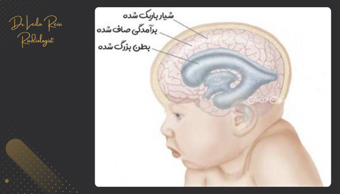 انواع بدشکلی های جمجمه نوزاد 